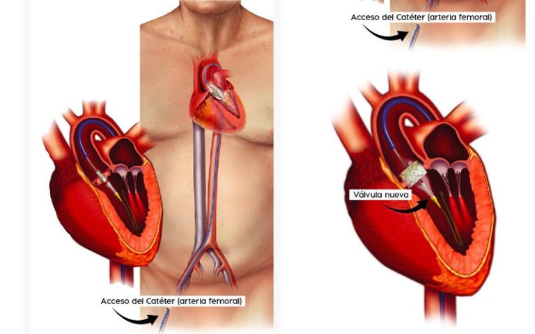 Épica historia de una mexicana: Reemplazo de Válvula Aórtica por Catéter